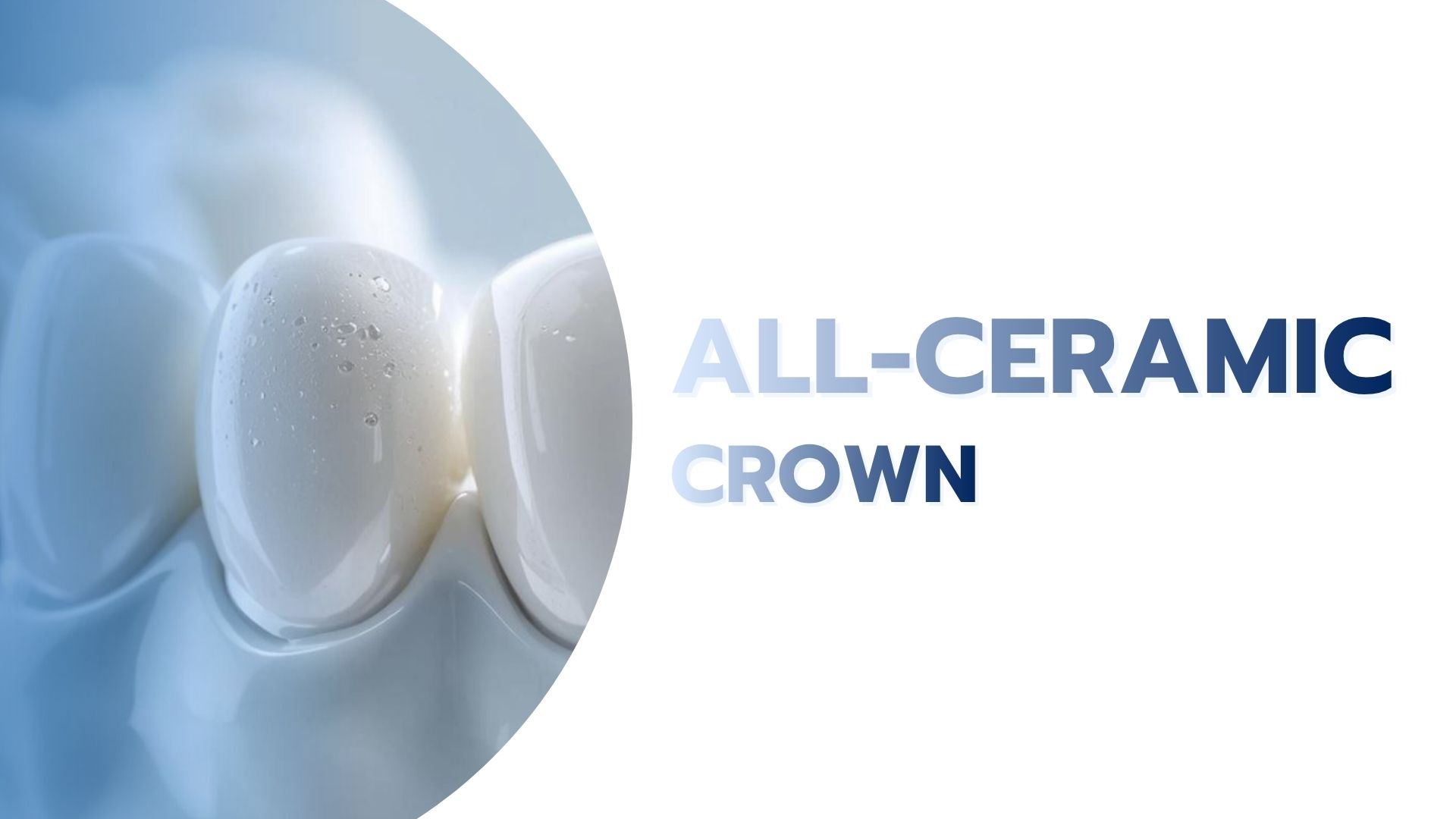 All-Ceramic Crown