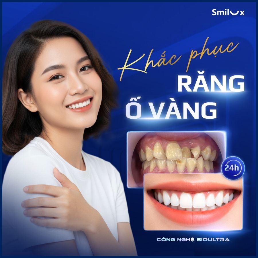 Banner 3 Bioultra răng sứ smilux