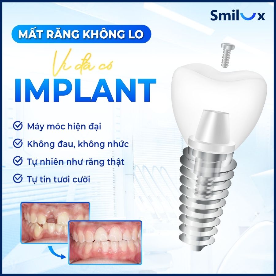 Banner 3 Oti Implant