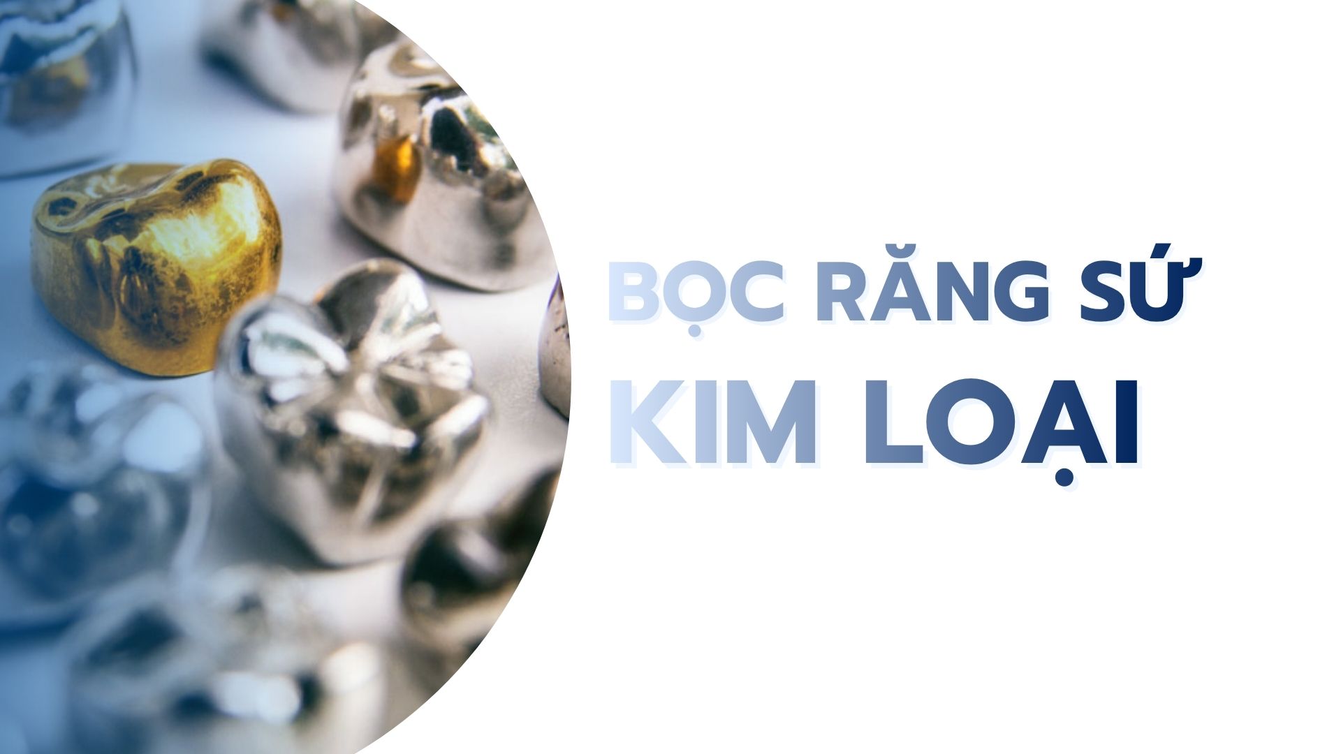 Bọc răng sứ kim loại