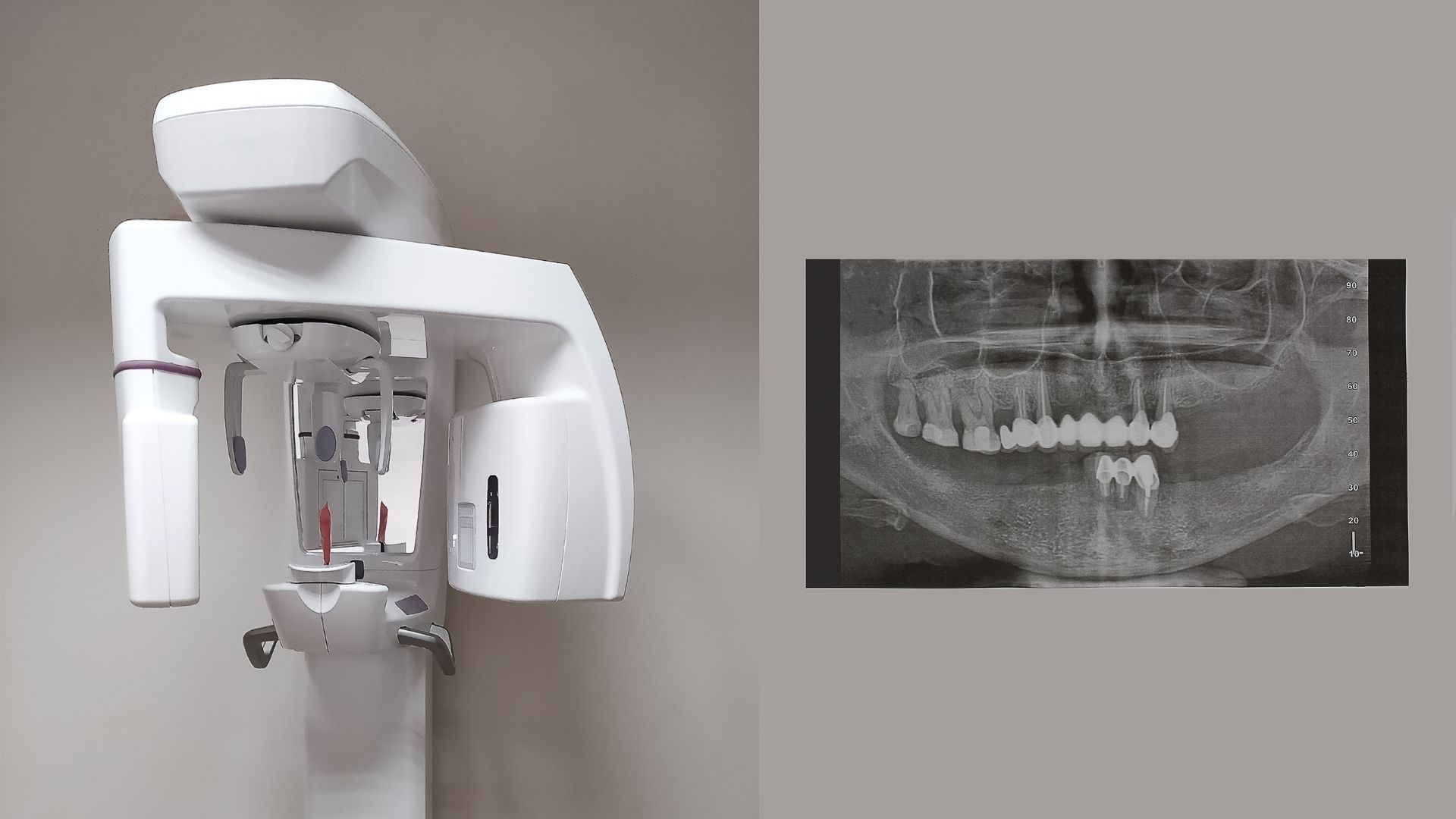 CT Cone Beam 3D_ Độ chính xác cao Hỗ trợ lập kế hoạch điều trị nha khoa, chỉnh nha, implant và phẫu thuật hàm mặt một cách chuẩn xác
