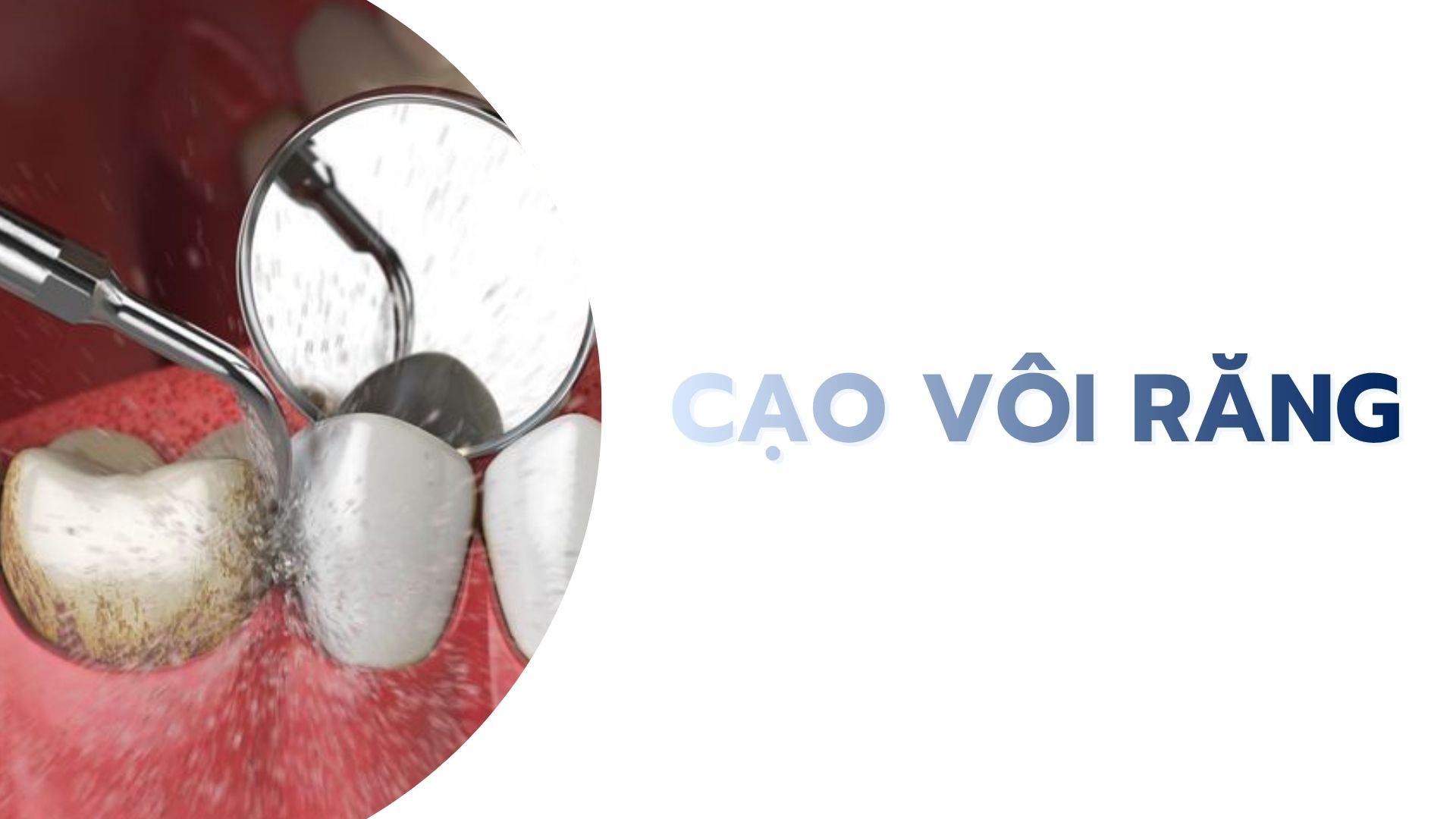 Cạo vôi răng