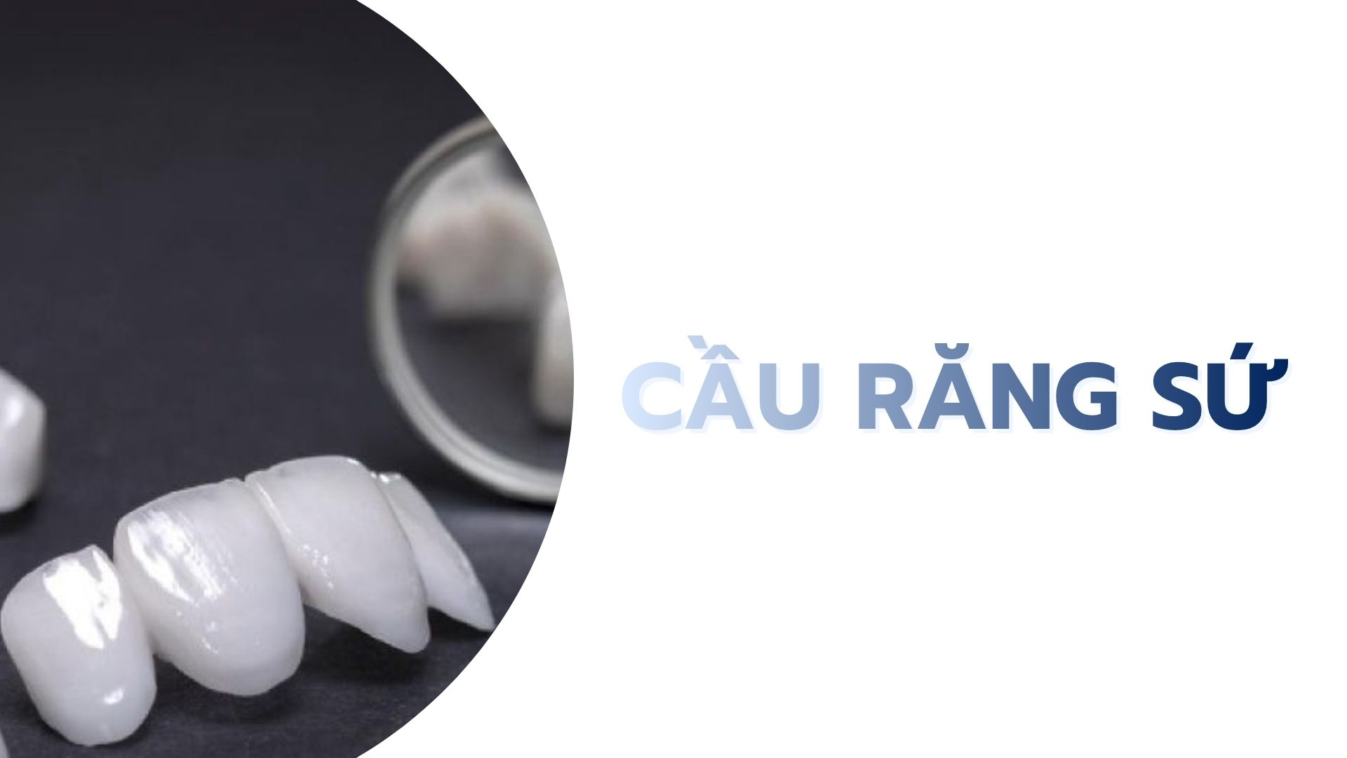 Cầu răng sứ