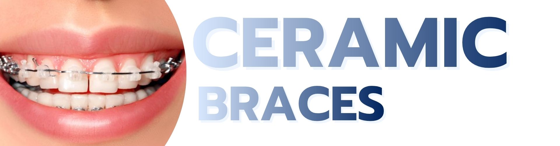 Ceramic Braces service