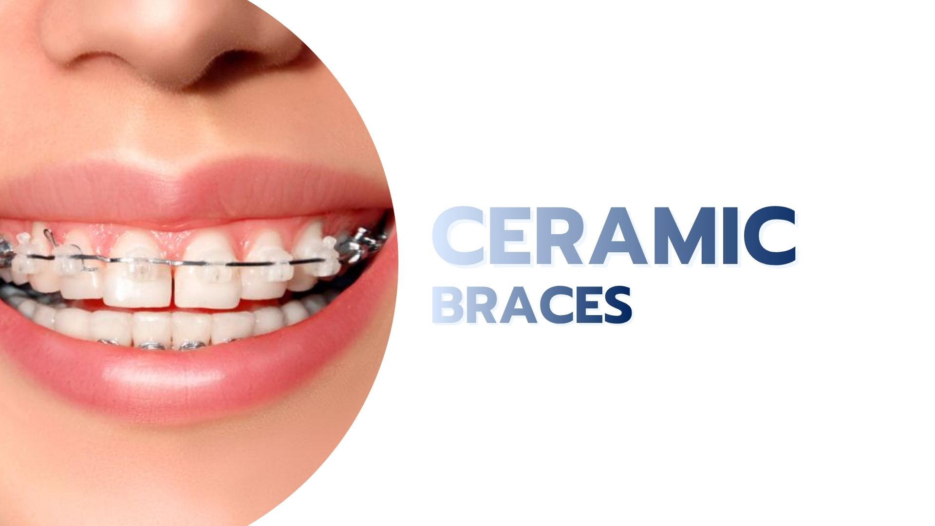 Ceramic Braces
