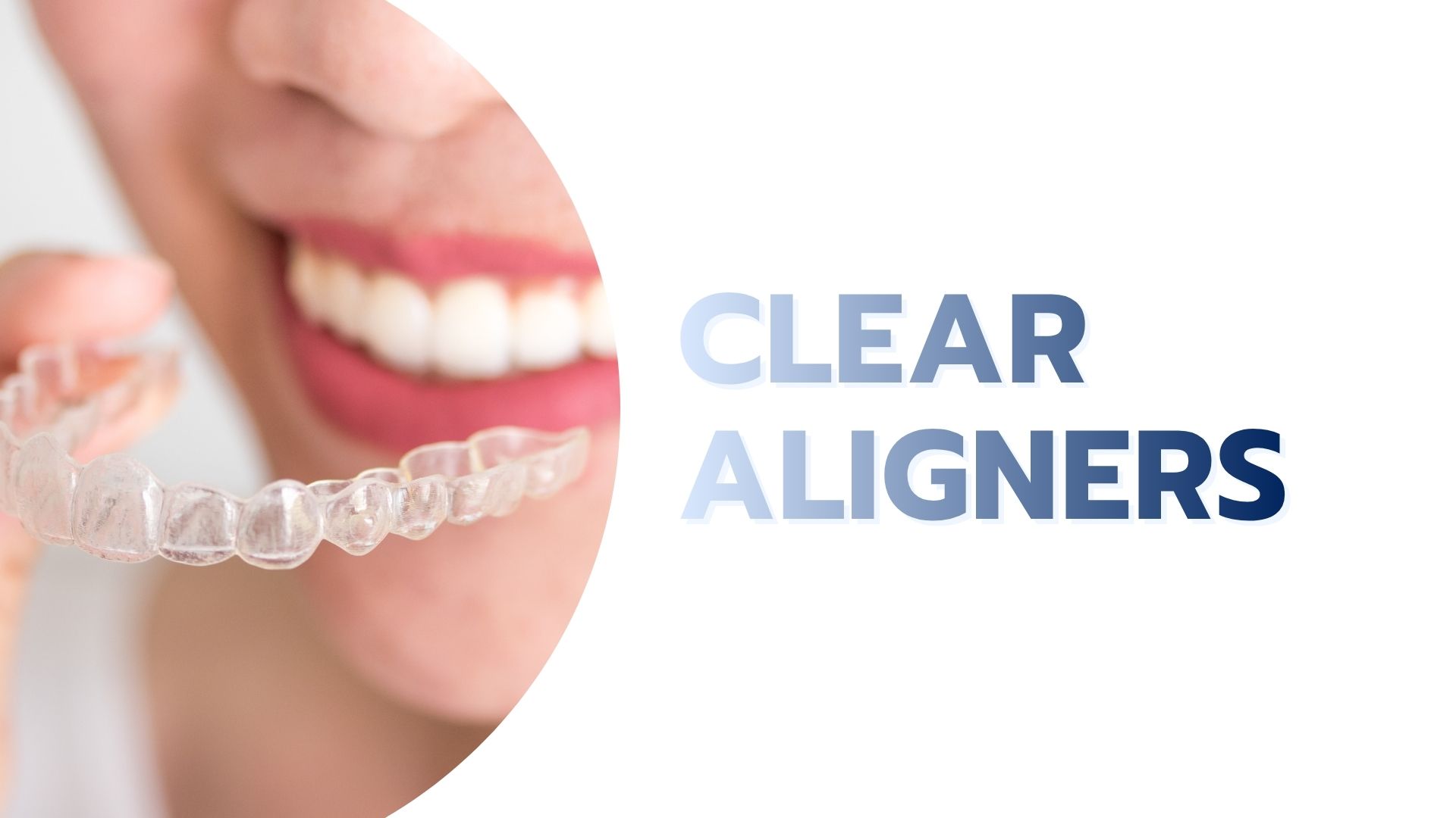 Clear Aligners