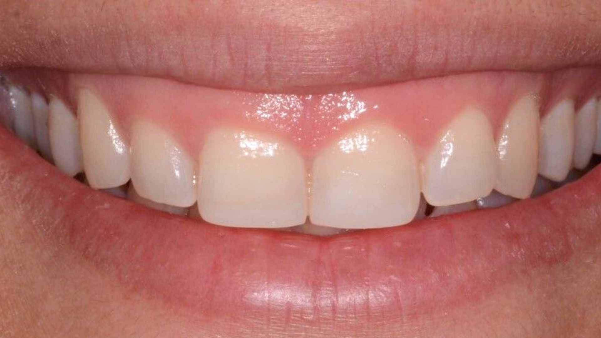 Cười hở lợi_ Khi nướu lộ lên trên 3mm khiến nụ cười kém duyên Gummy smile_ When the gums are exposed more than 3mm, making the smile less attractive