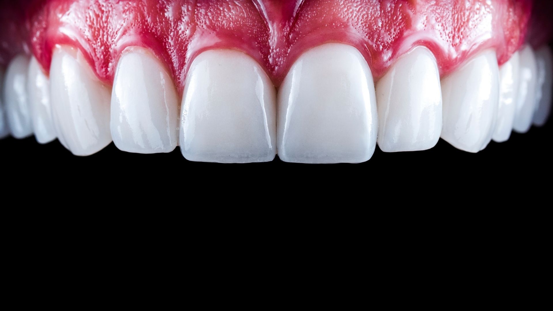 DÒNG SỨ VENEER EMAX