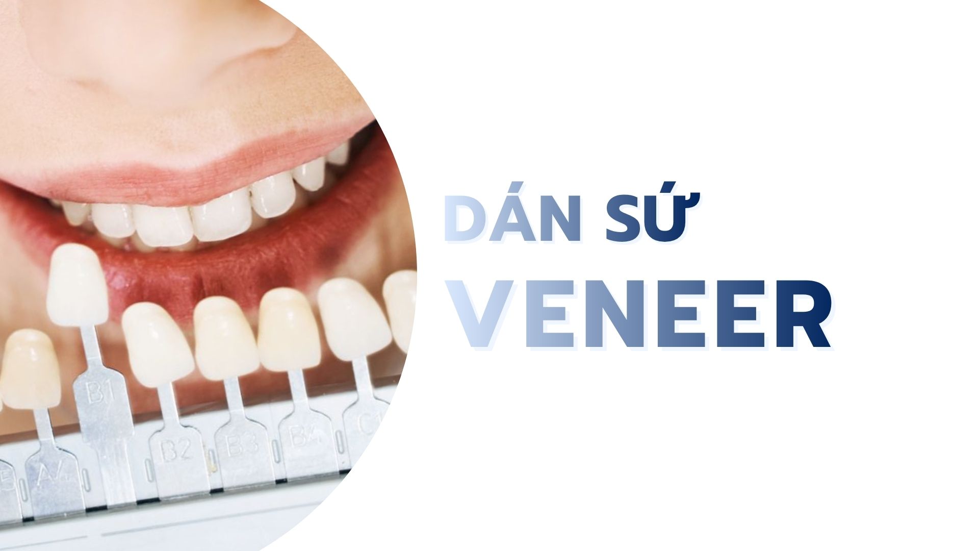 Dán răng sứ Veneer