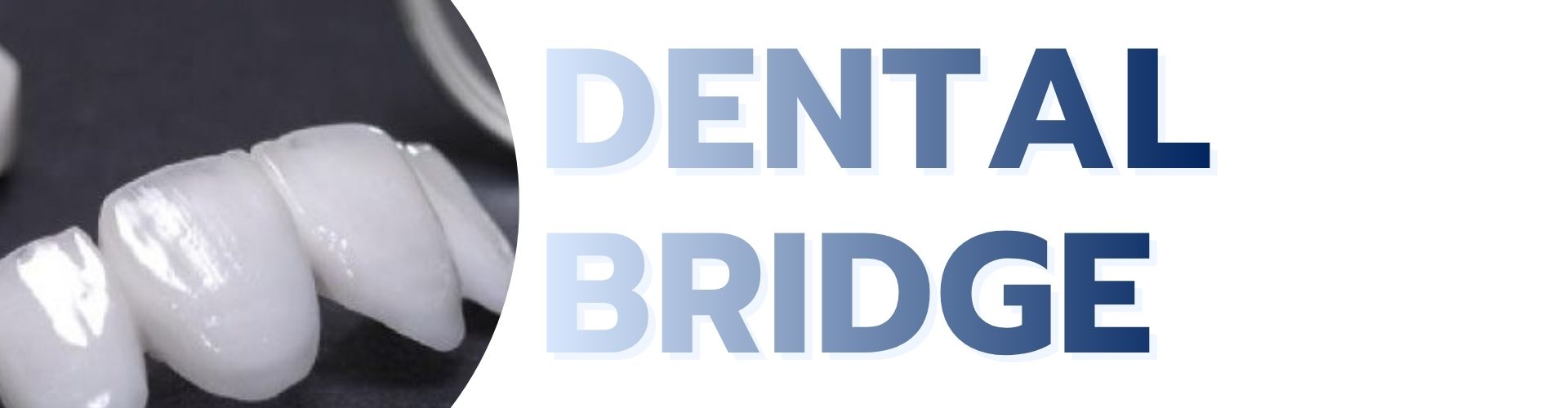 Dental Bridge service