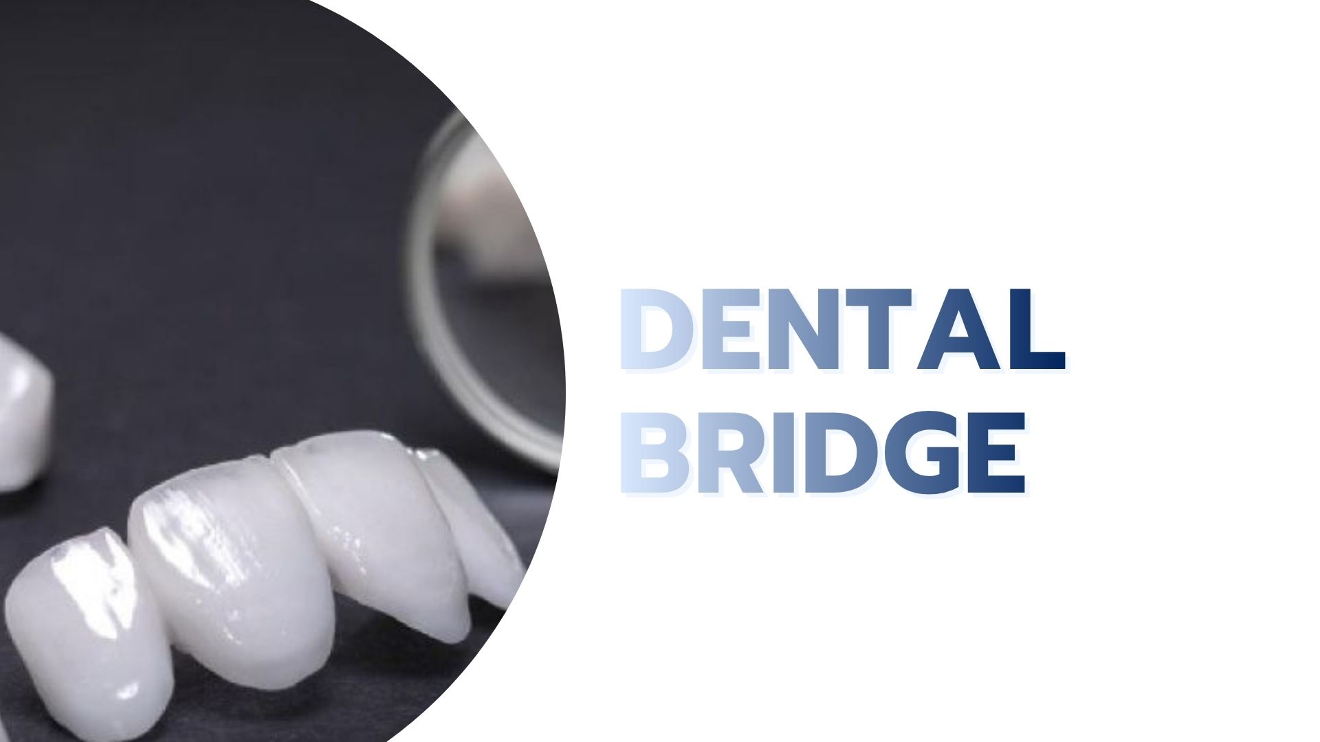 Dental Bridge