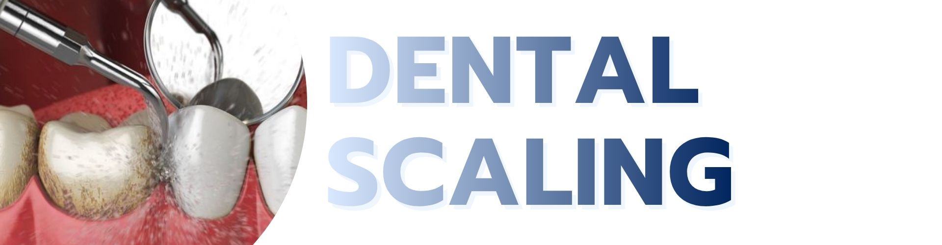 Dental Scaling service