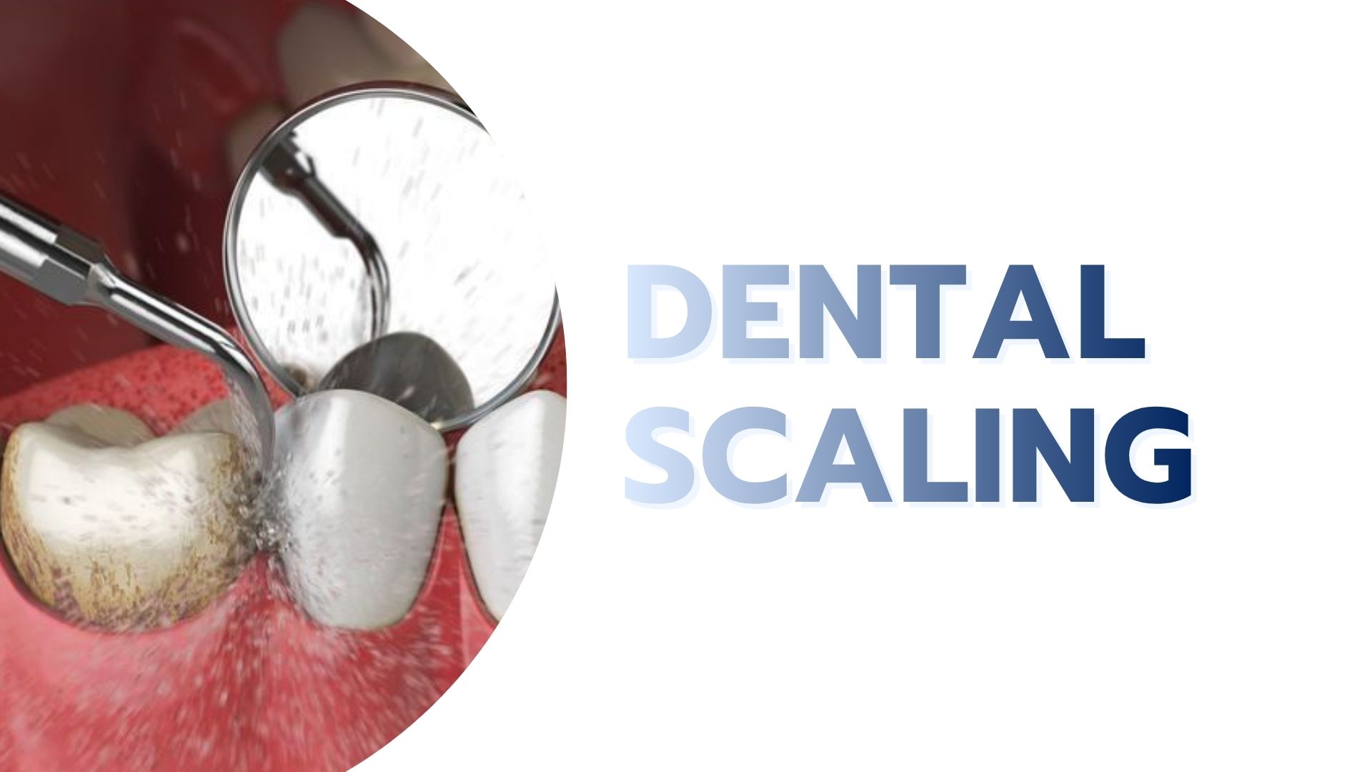 Dental Scaling