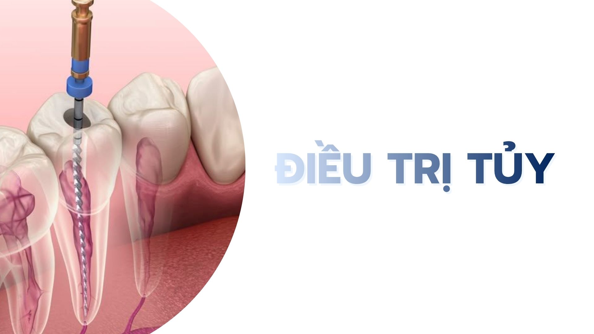 Điều trị tủy