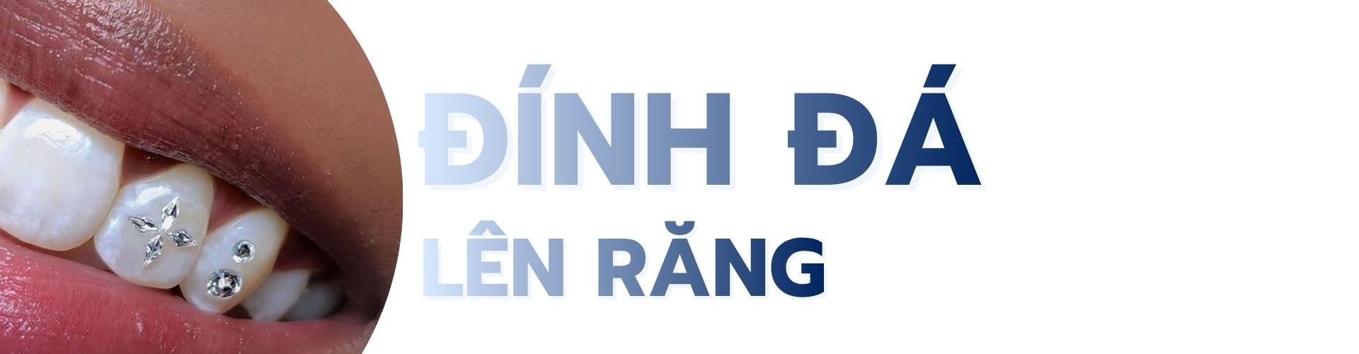 Đính đá lên răng tại TPHCM quận phú nhuận