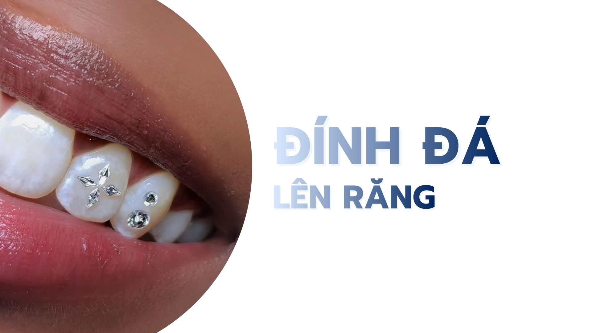 Đính đá lên răng không khoan lỗ