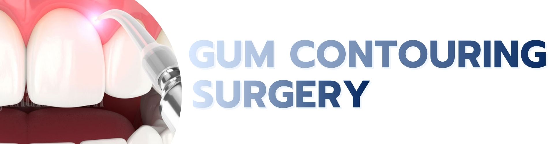 Gum Contouring Surgery service
