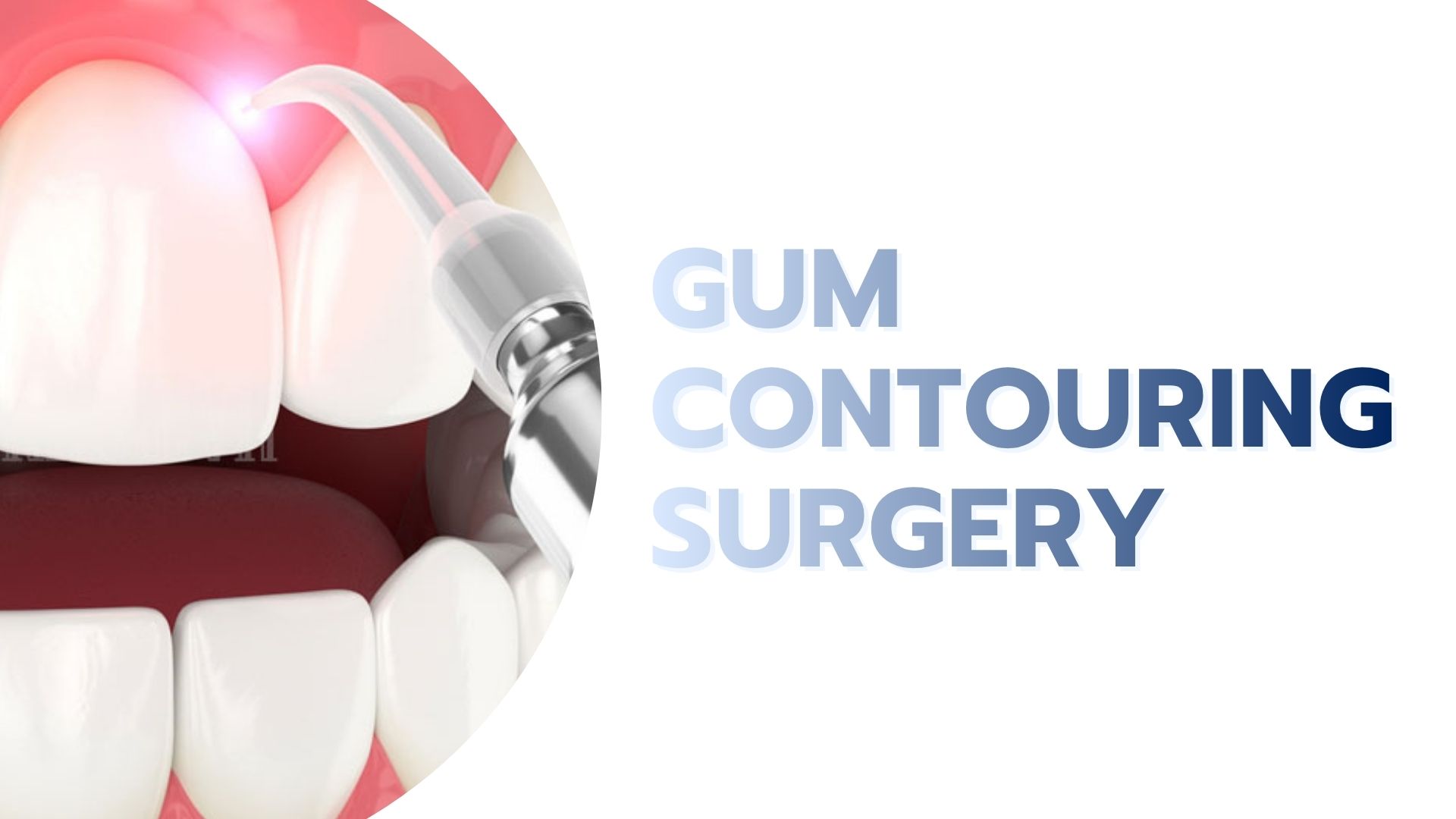 Gum Contouring Surgery