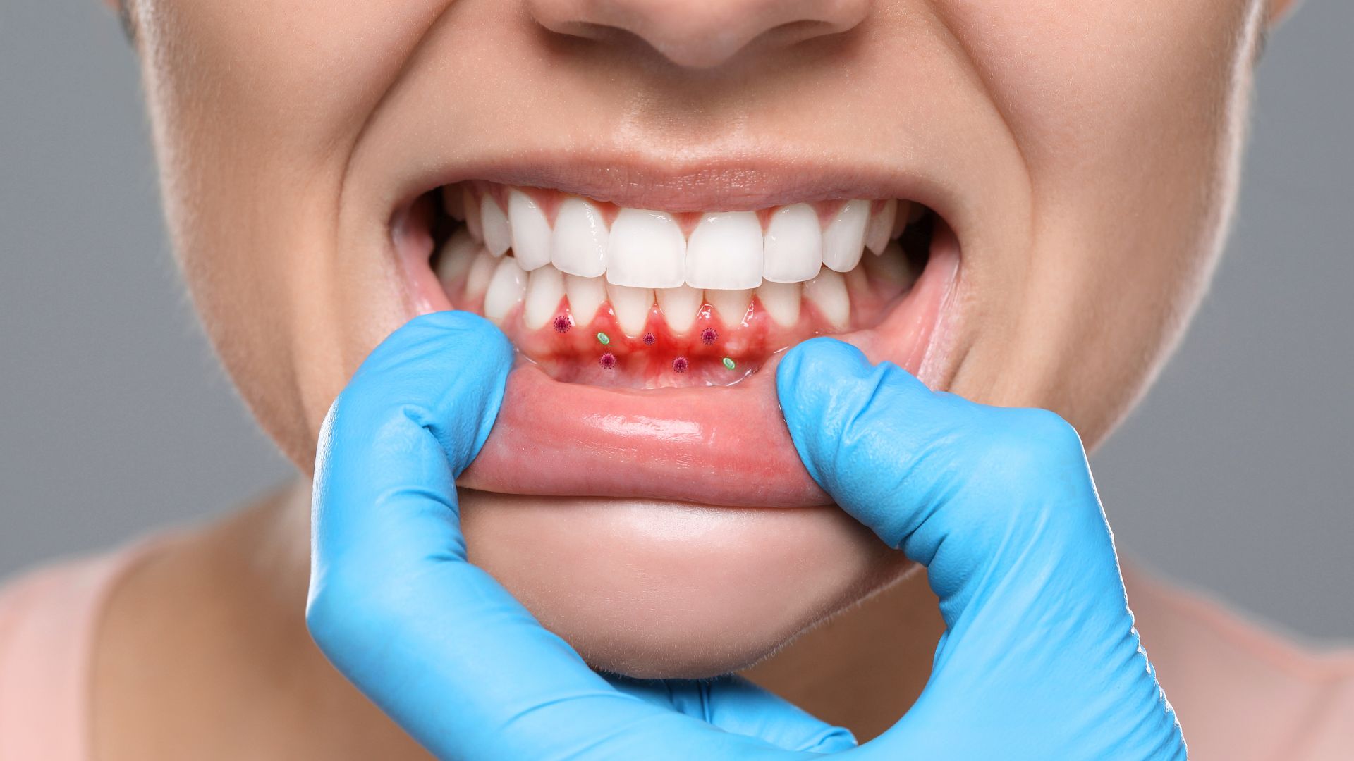 Hôi miệng_ Do vi khuẩn trú ẩn trong lớp vôi dưới nướu. Bad breath_ Caused by bacteria hiding in the layer of tartar under the gums