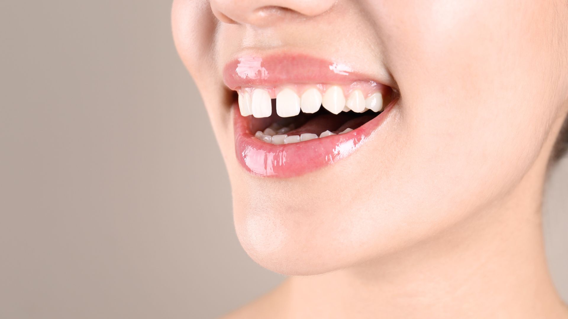 Kẽ răng thưa, nhỏ, lệch_ Tạo nụ cười đều đẹp, tự nhiên, cân đối hơn Gaps between teeth, small, crooked_ Create a more beautiful, natural, and balanced smile