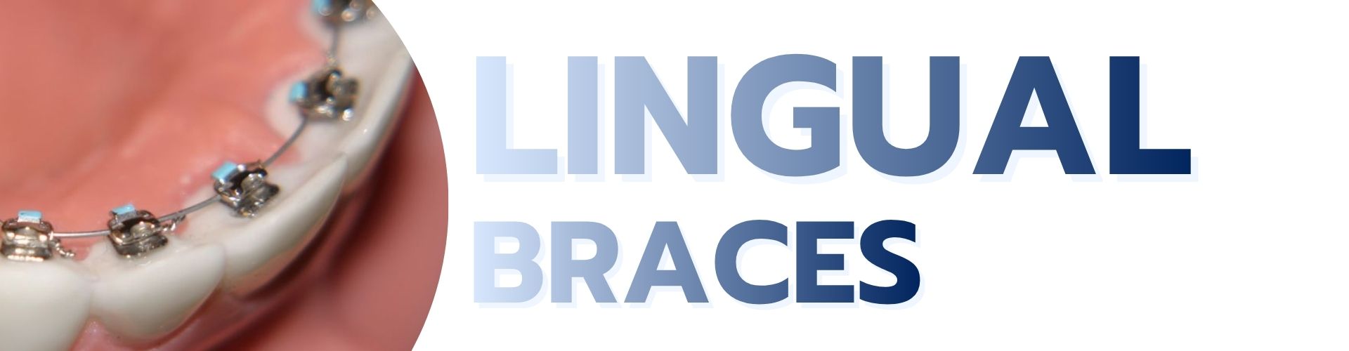 Lingual Braces service
