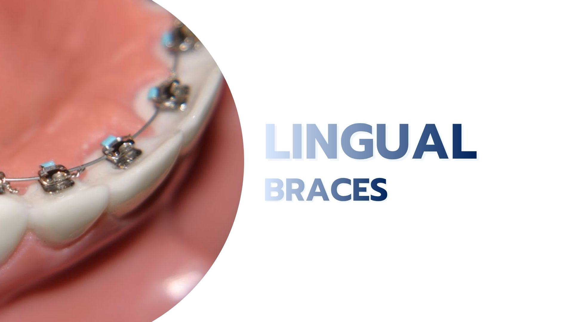 Lingual Braces