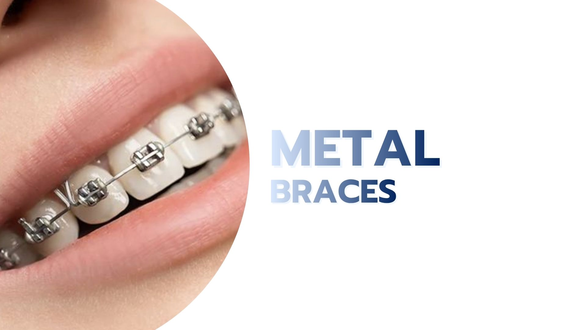 Metal Braces