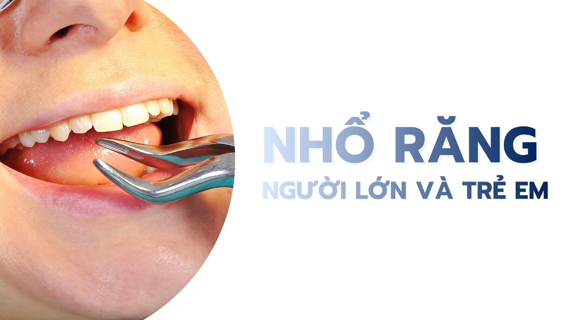 Nhổ răng người lớn và trẻ em