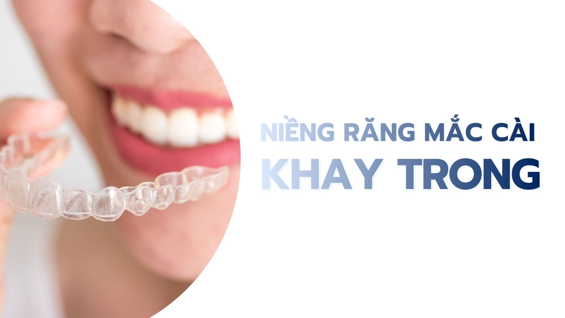 Niềng răng khay trong, trong suốt