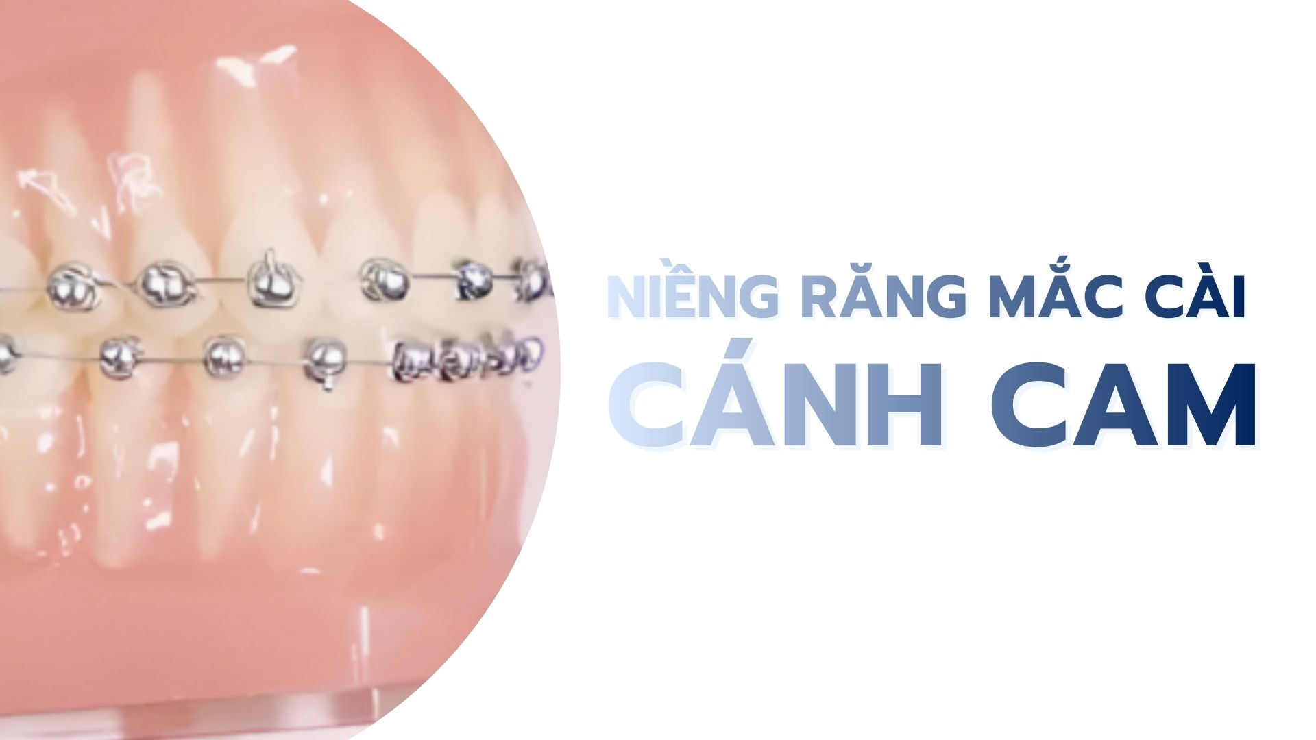 Niềng răng mắc cài cánh cam