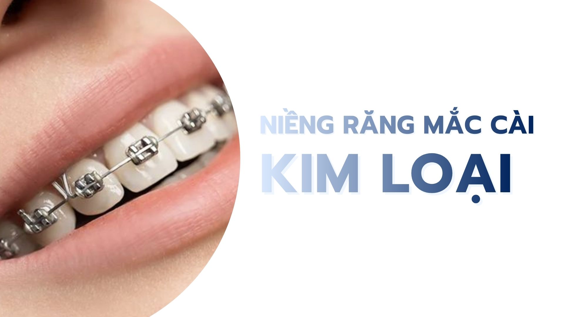 Niềng răng mắc cài kim loại