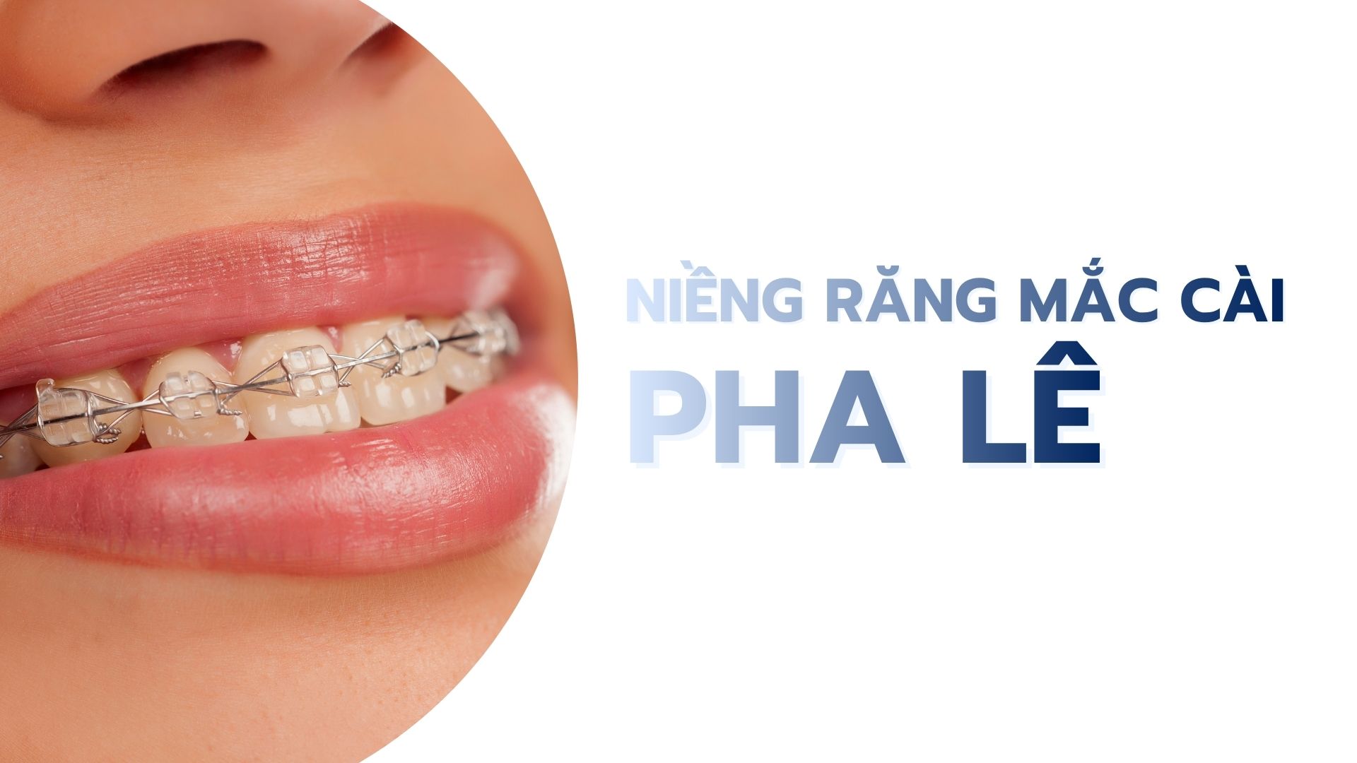 Niềng răng mắc cài pha lê
