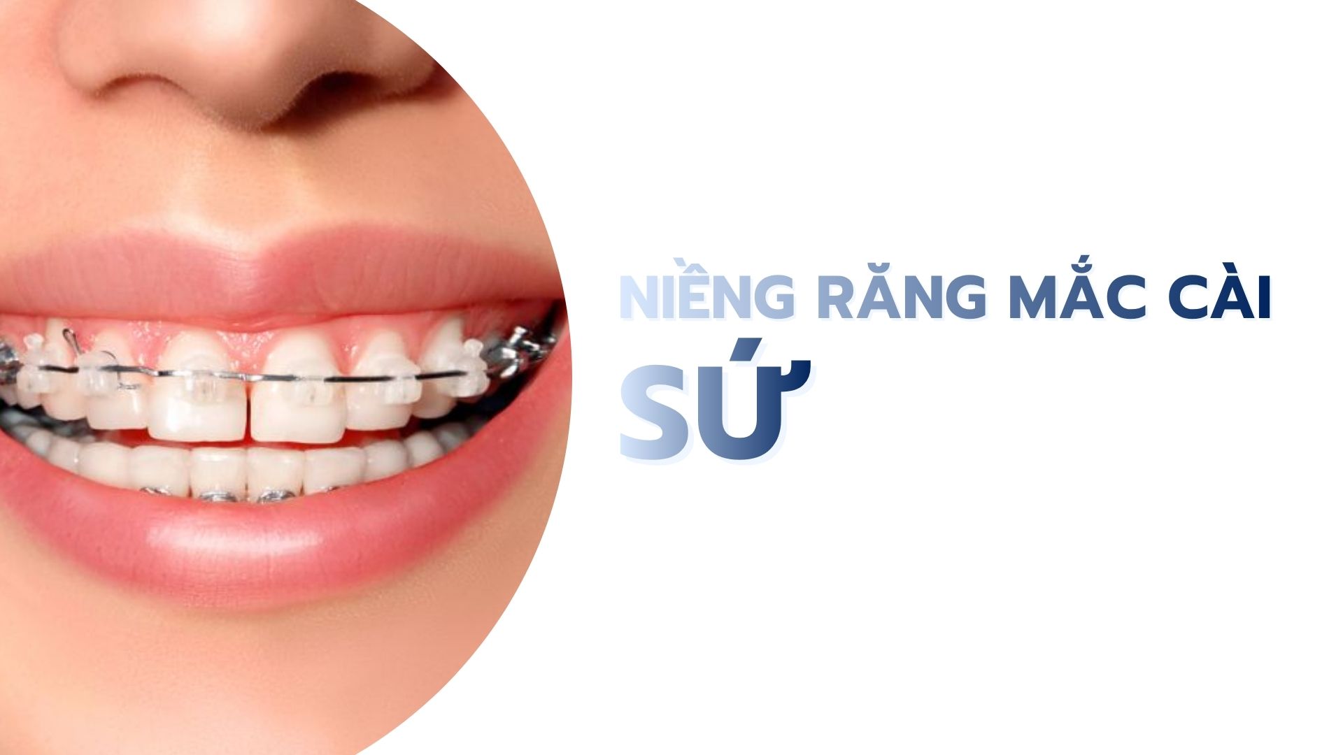 Niềng răng mắc cài sứ