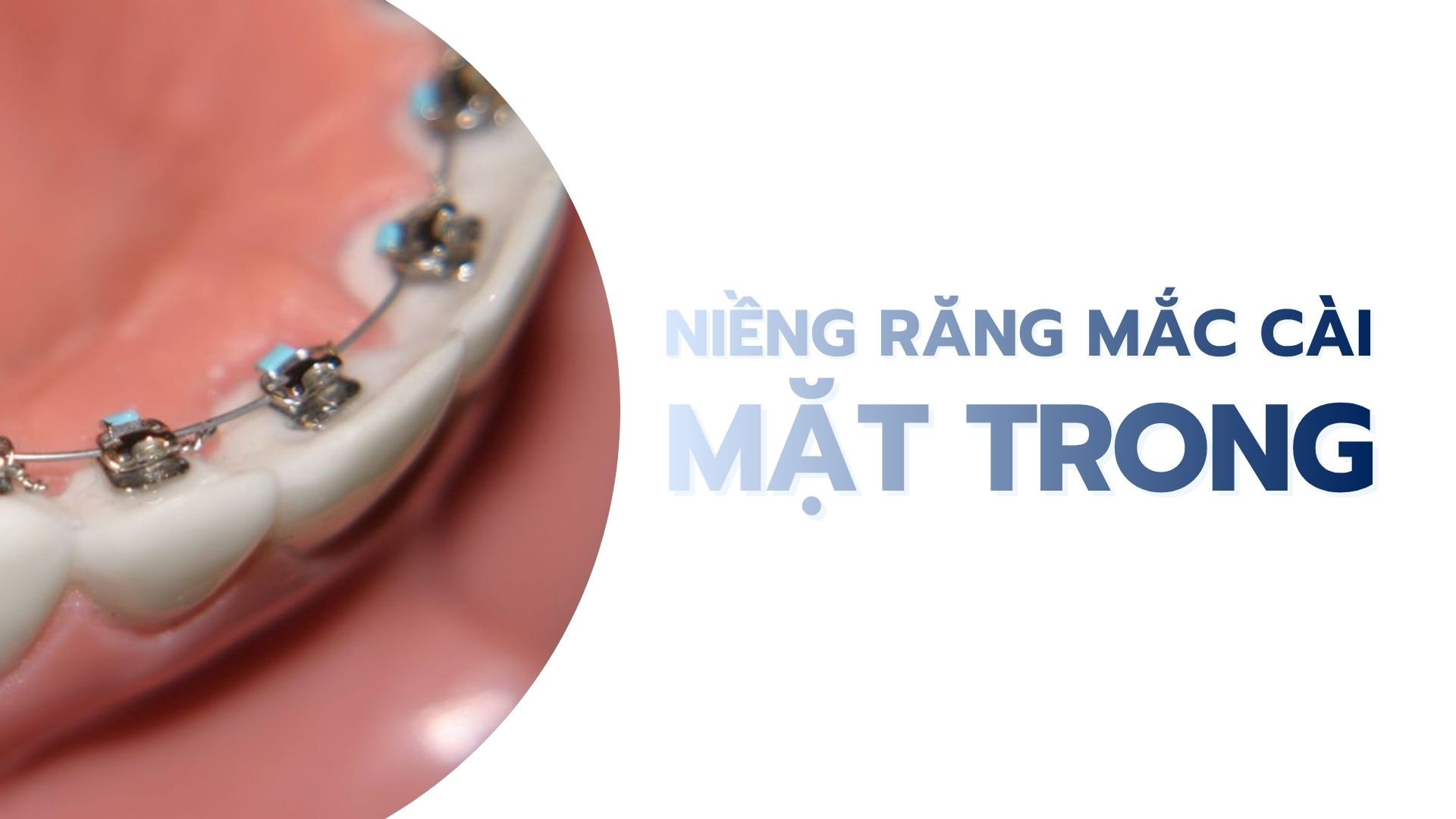 Niềng răng mặt trong