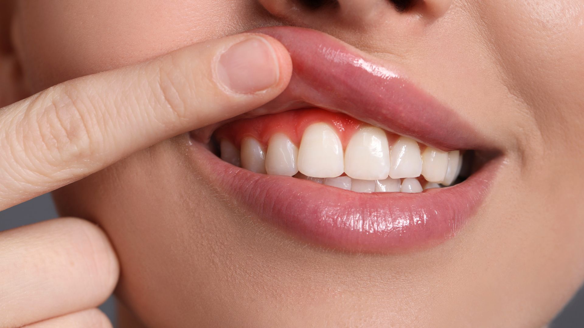 Nướu phì đại sau niềng_ Nướu dày, sưng phồng, mất dáng răng Gingival hypertrophy after braces_ Thick, swollen gums, loss of tooth shape