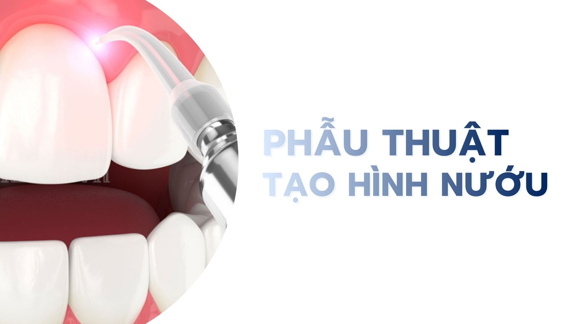 Phẫu thuật tạo hình nướu