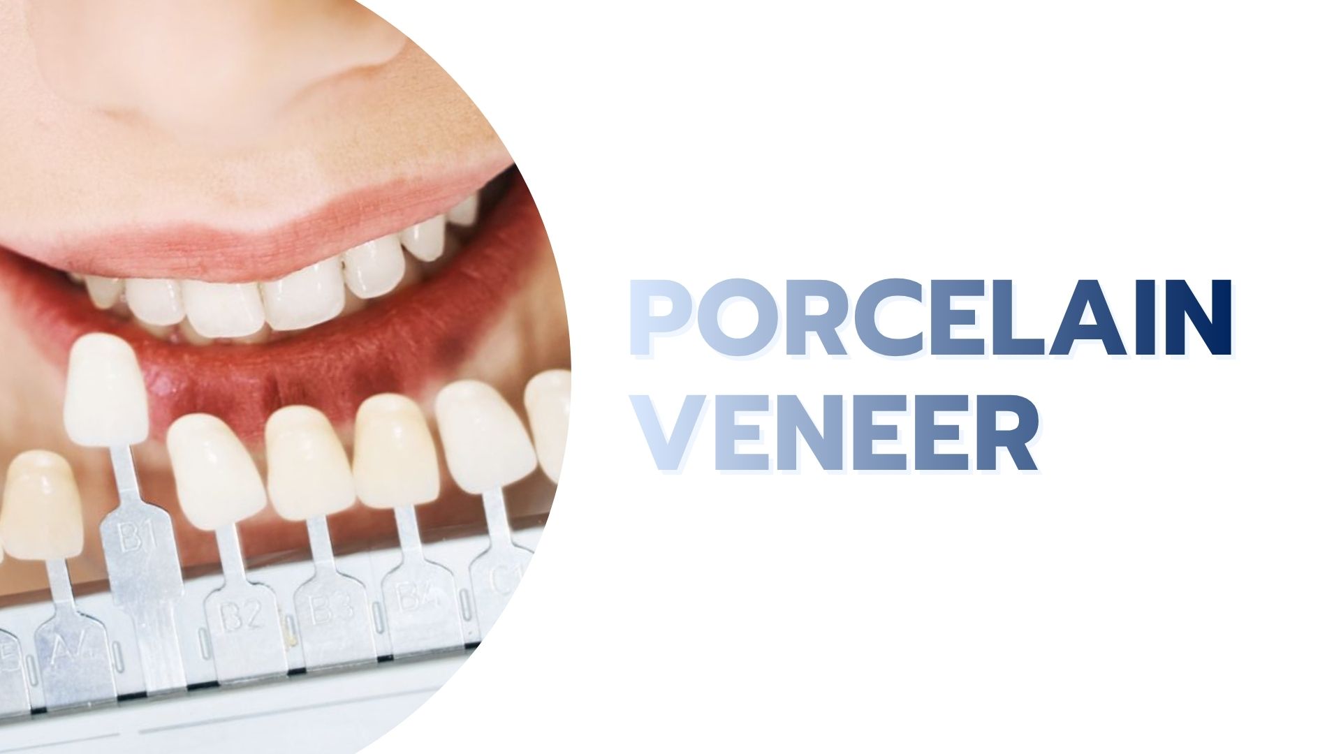 Porcelain Veneer