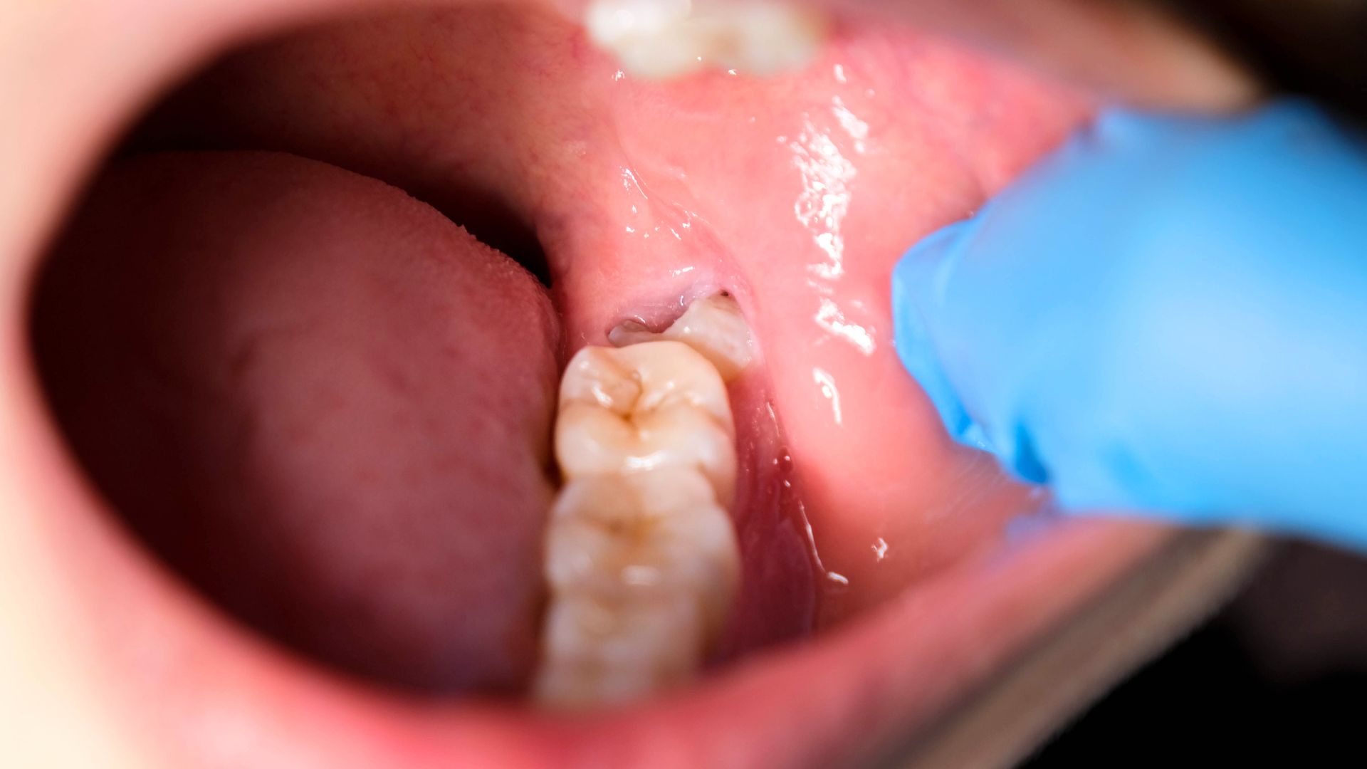 Răng khôn mọc lệch Impacted wisdom teeth