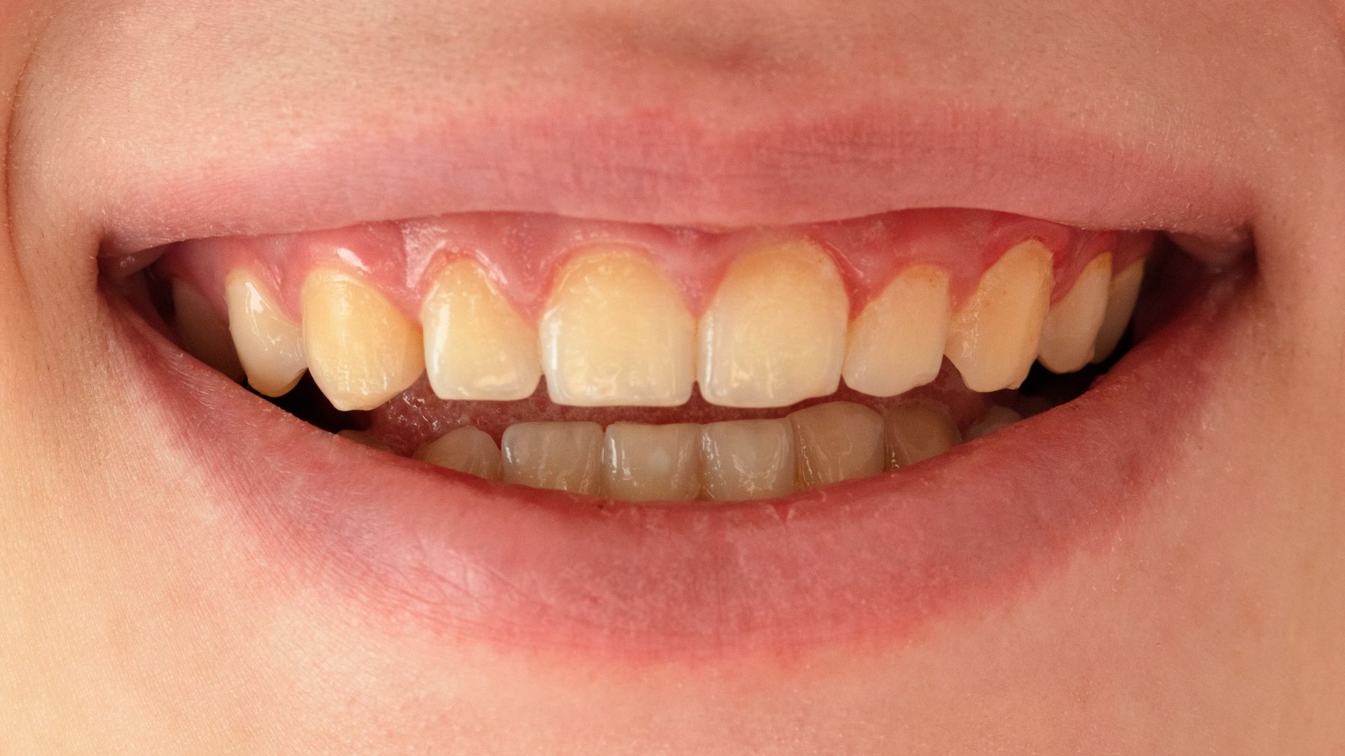 Răng ngắn_ Nướu phủ lên thân răng, làm răng kém thanh thoát Short teeth_ Gums cover the tooth crown, making the tooth less elegant