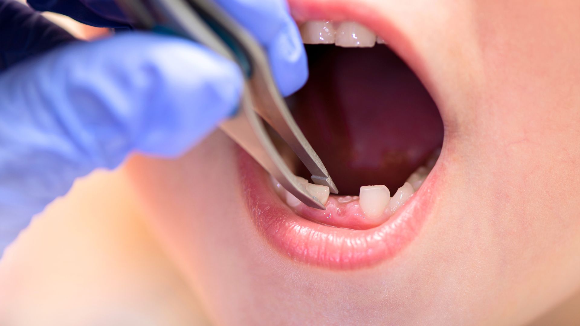 Răng sữa trẻ em Baby teeth