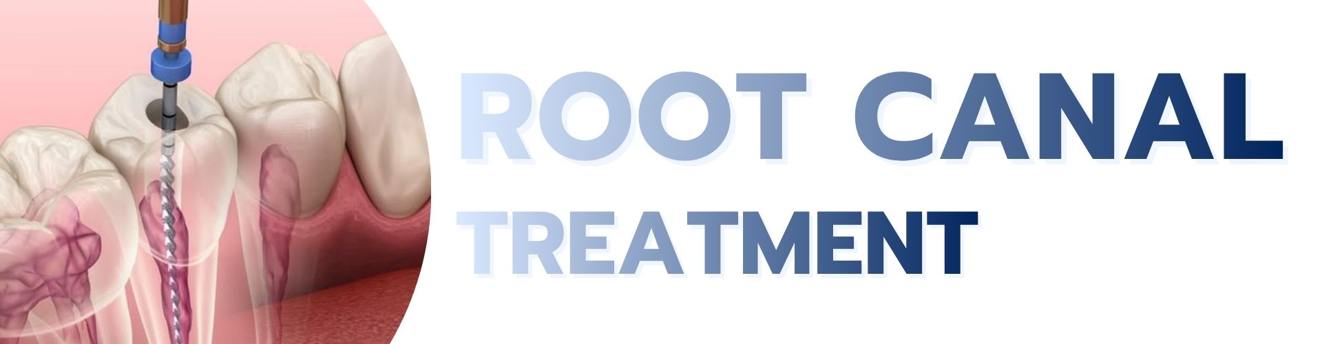 Root Canal Treatment service