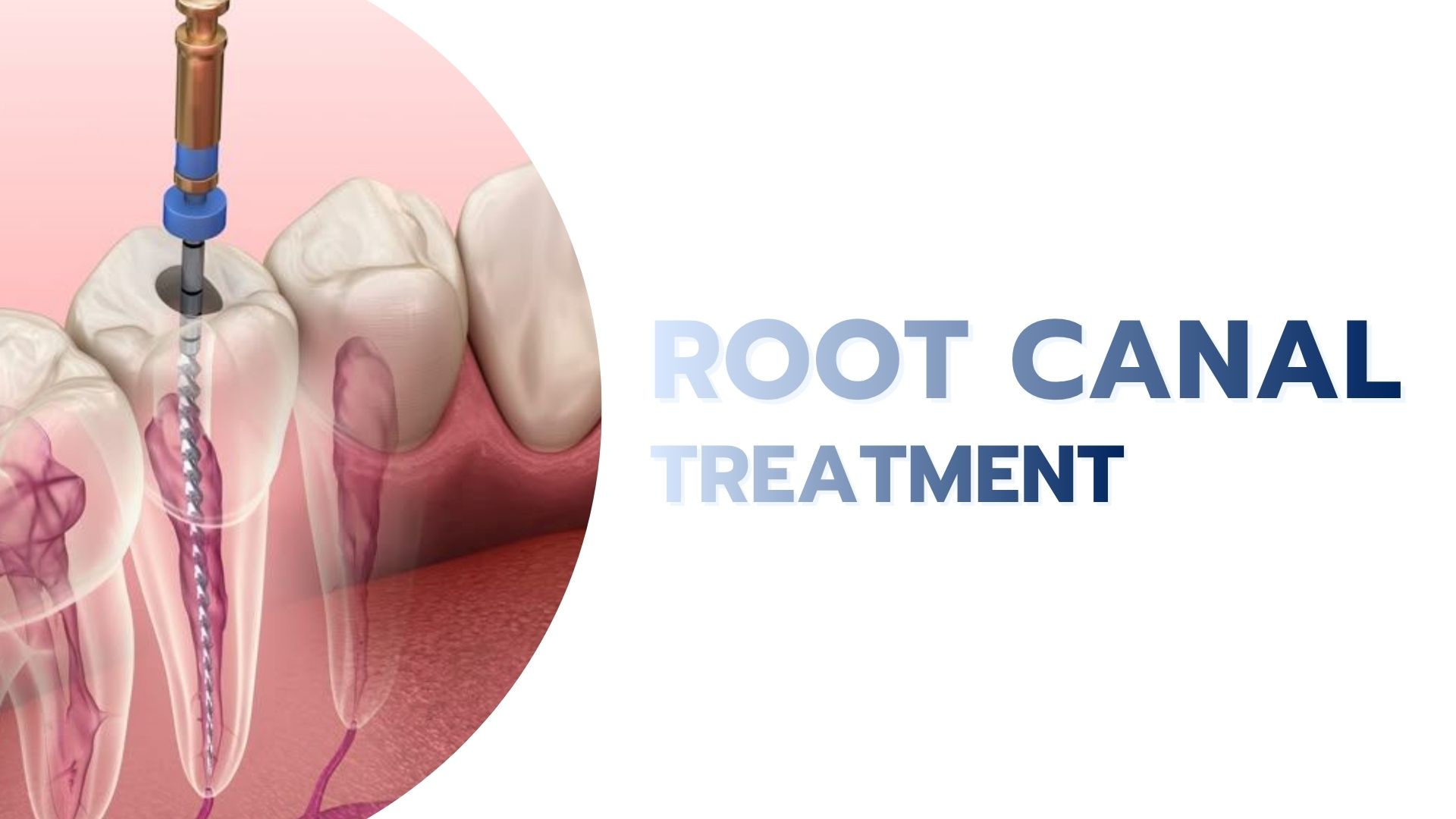Root Canal Treatment