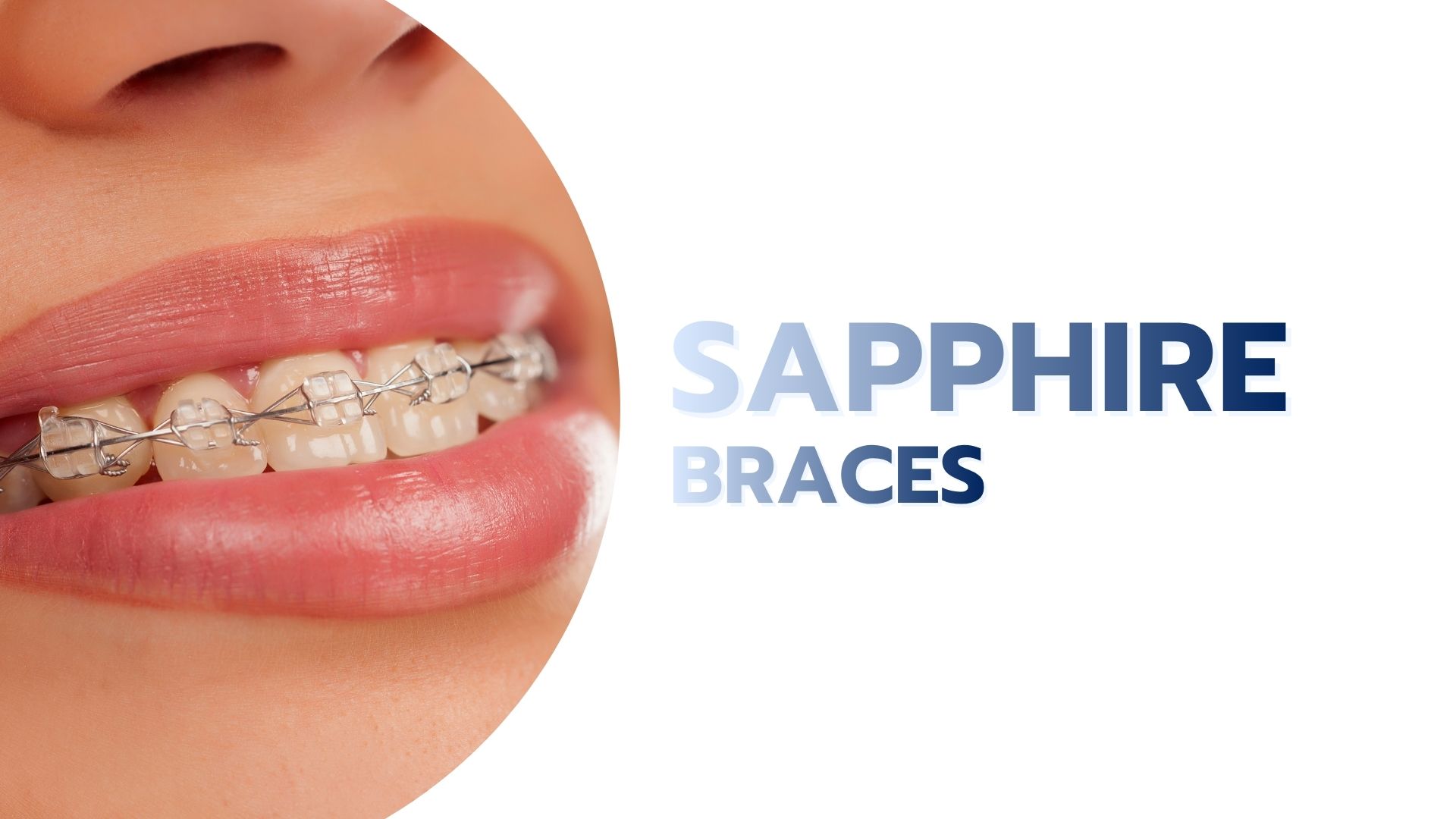 Sapphire-Braces.jpg