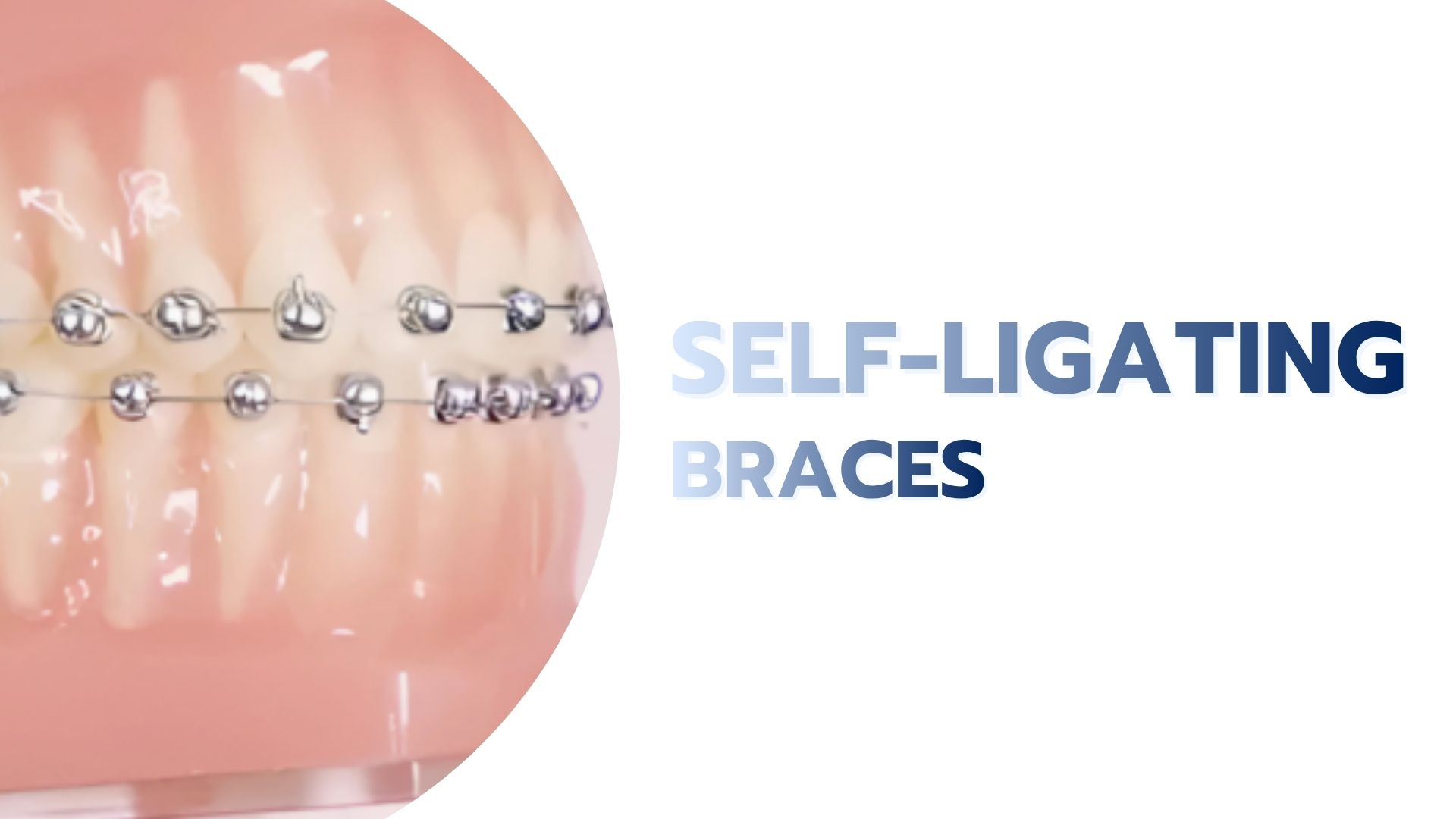 Self-Ligating-Braces.jpg