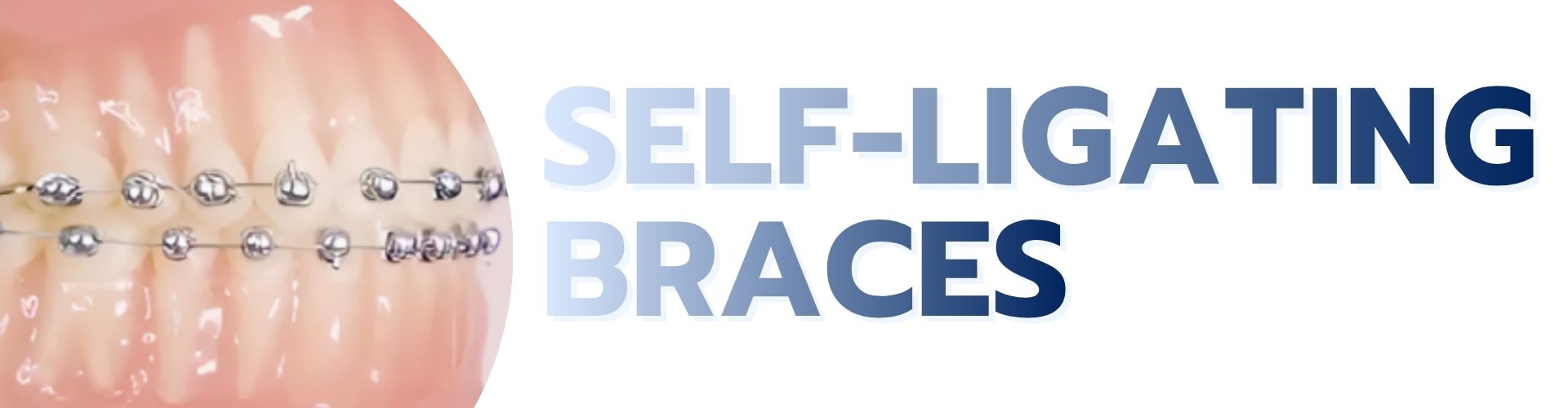 Self-Ligating Braces service