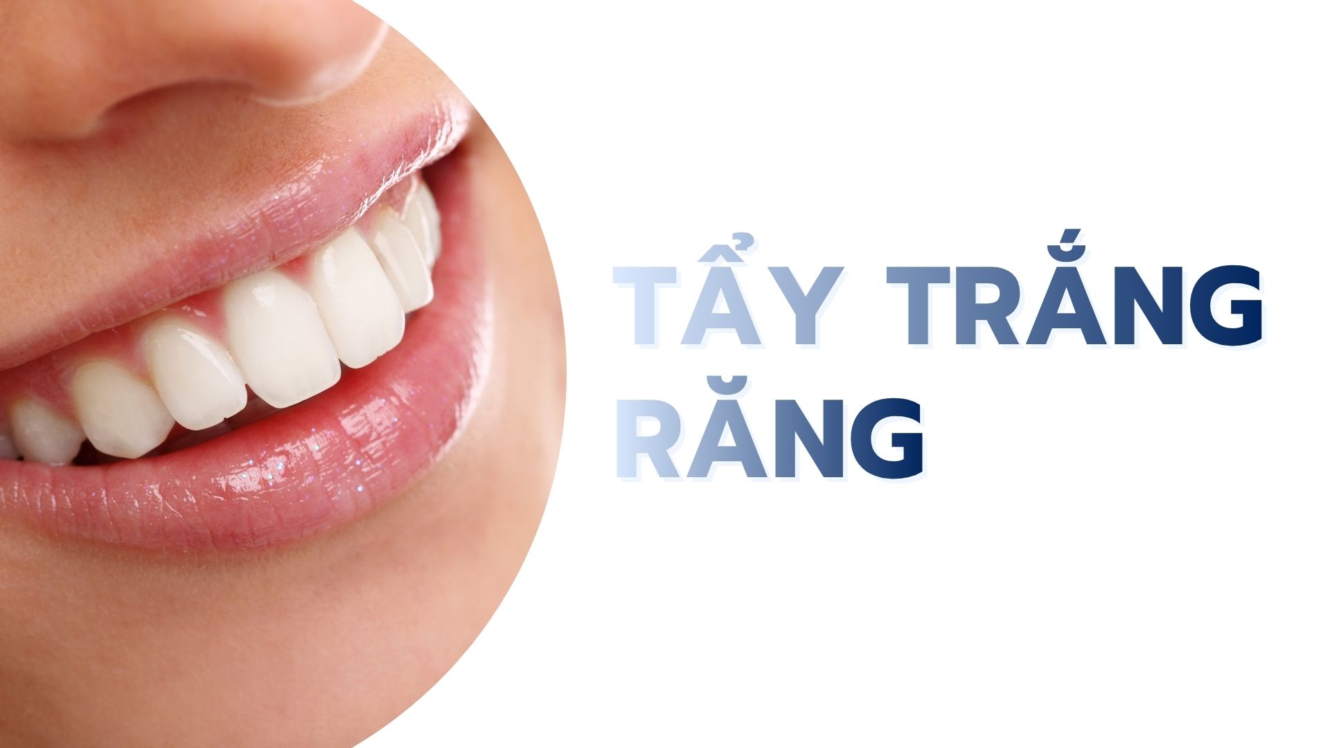Tẩy trắng răng