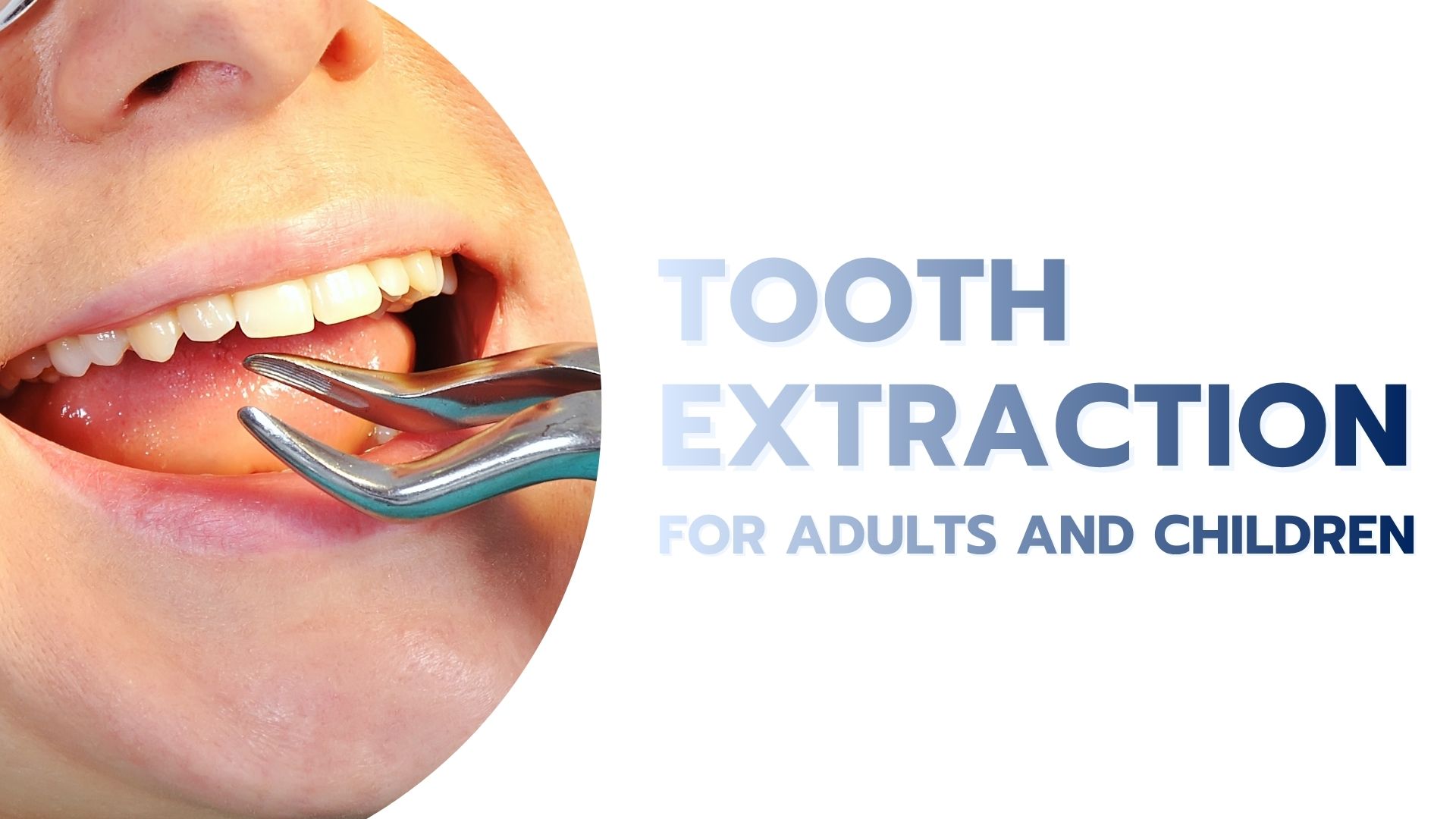 Tooth Extraction for Adults and Children