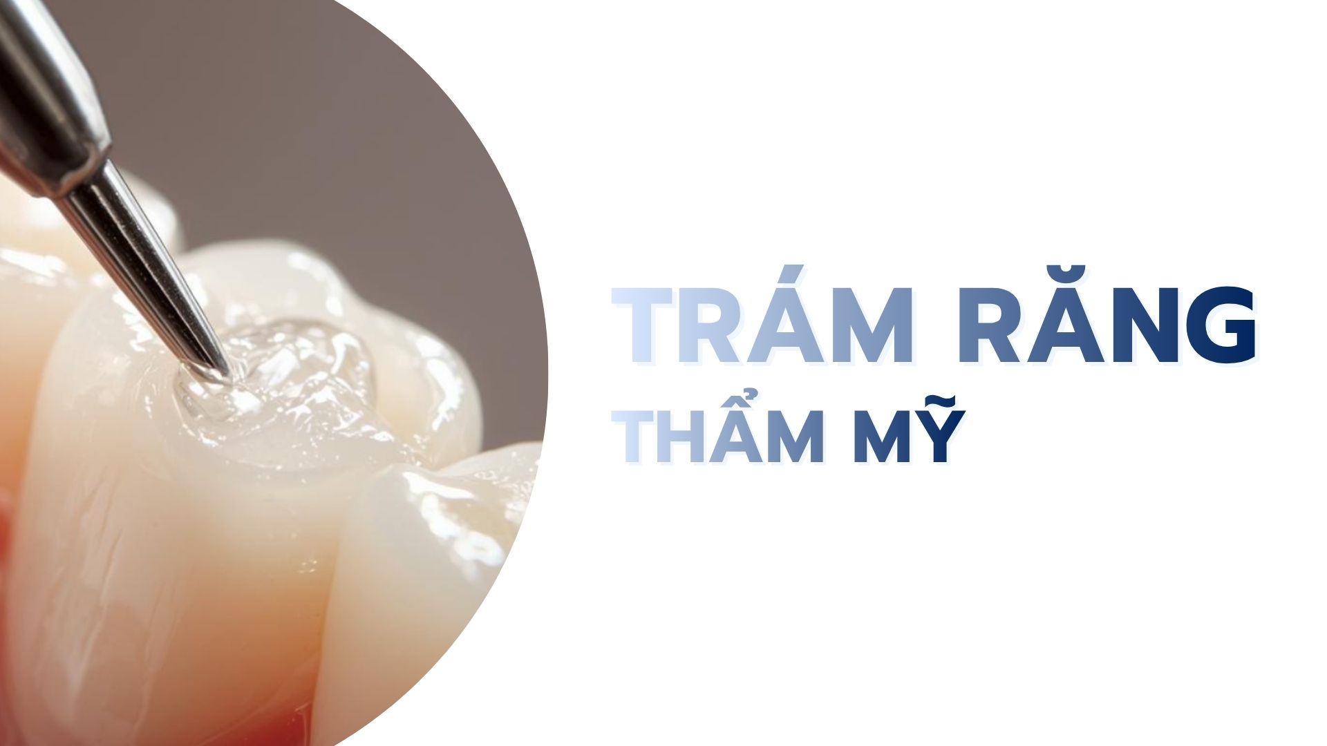 Trám răng thẩm mỹ