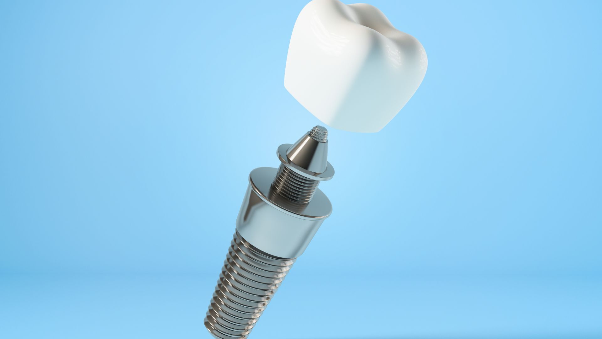 Trồng răng implant Dễ bảo trì, tháo lắp mão sứ khi cần mà không ảnh hưởng trụ Dental implants are easy to maintain and remove the porcelain crown when needed without affecting the implant