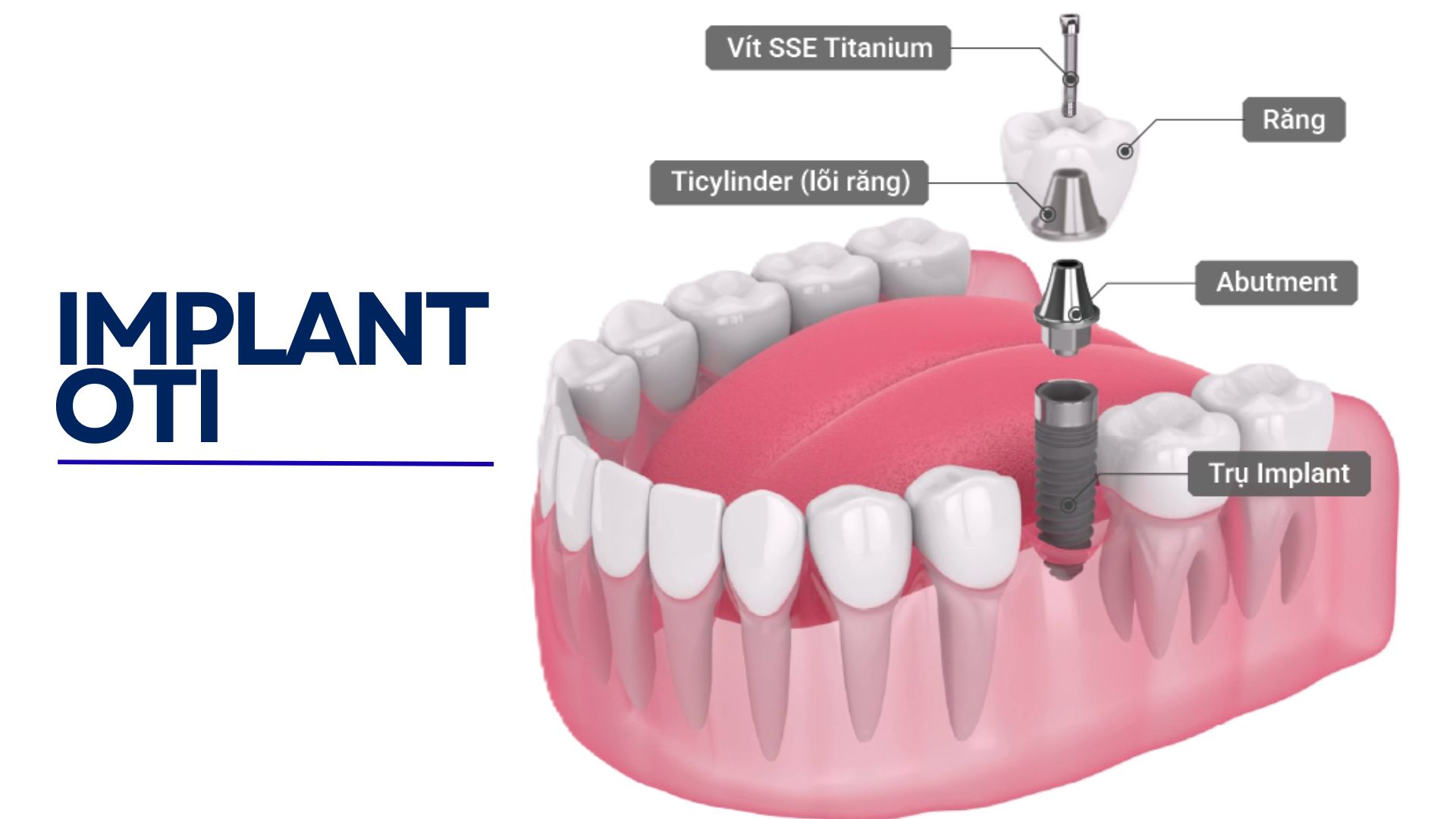 Trồng răng implant OTI Vít Trong Vít độc quyền không dùng xi măng OTI Dental Implants Exclusive Screw-In-Screw without Cement